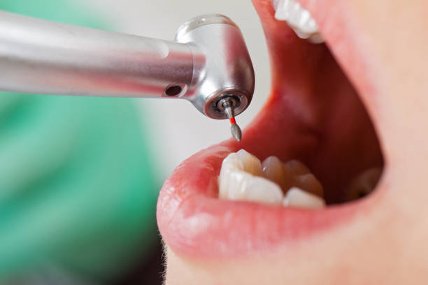 Best Emergency Dental Care for Broken or Chipped Teeth in Spring City, UT